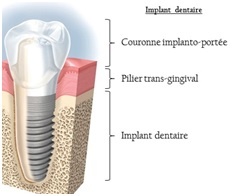 implant dentaire